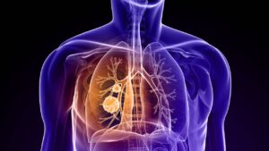 cancer de pulmon2